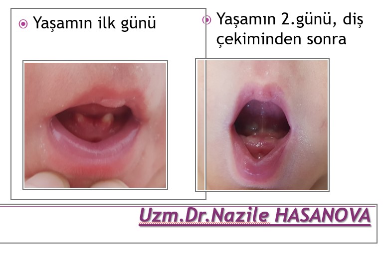 Yenidoğan Bebekte Diş