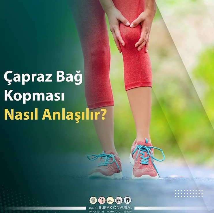 Çapraz Bağ Kopması Nasıl Anlaşılır?