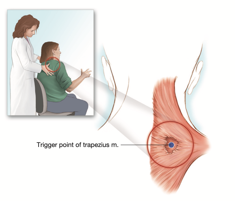 Boyun kaslarında Fibromyalji