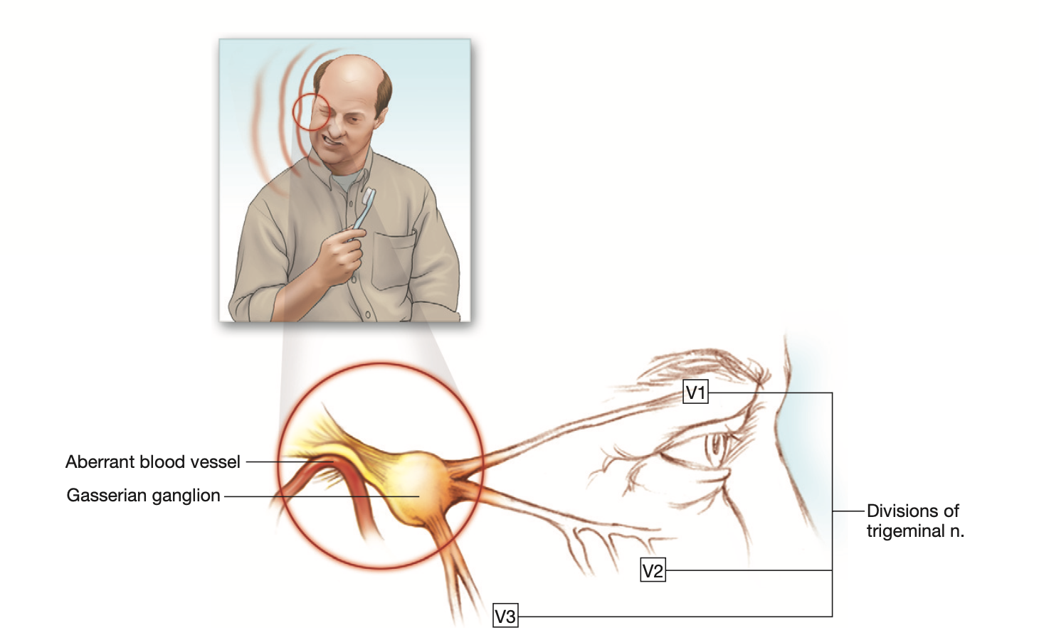 Yüz Ağrısı-Trigeminal Nevralji