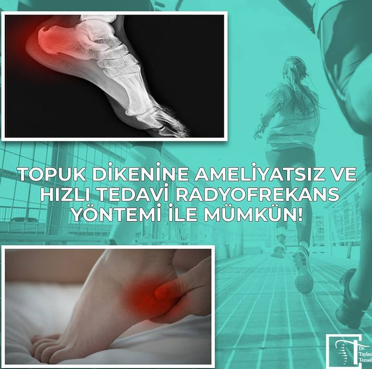 Topuk dikenine ameliyatsız ve hızlı tedavi radyofrekans yöntemi ile mümkün!