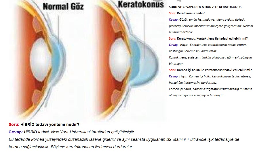 SORU VE CEVAPLARLA A’DAN Z’YE KERATOKONUS VE HİBRİD TEDAVİ