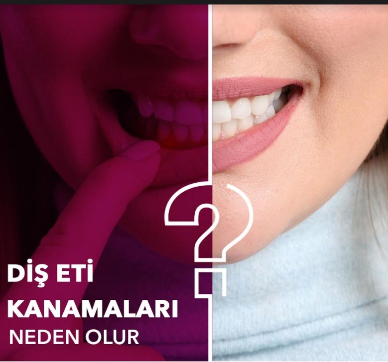 Diş eti kanaması neden oluşur? makalesi