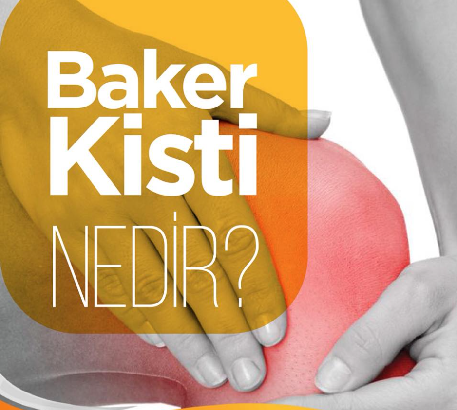 BAKER KİSTİ NEDİR ?