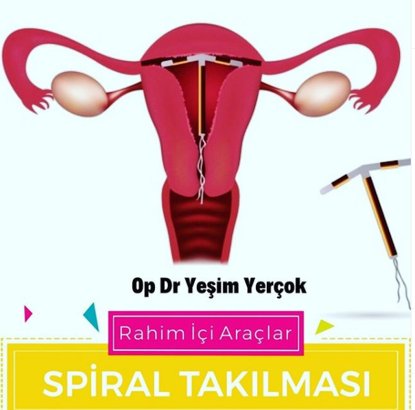 Rahim İçi Araçlar: Spiral Takılması