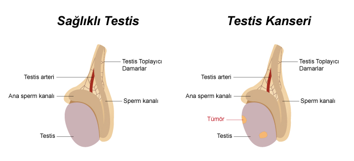 Testis Kanseri Hakkında Bilgilendirme