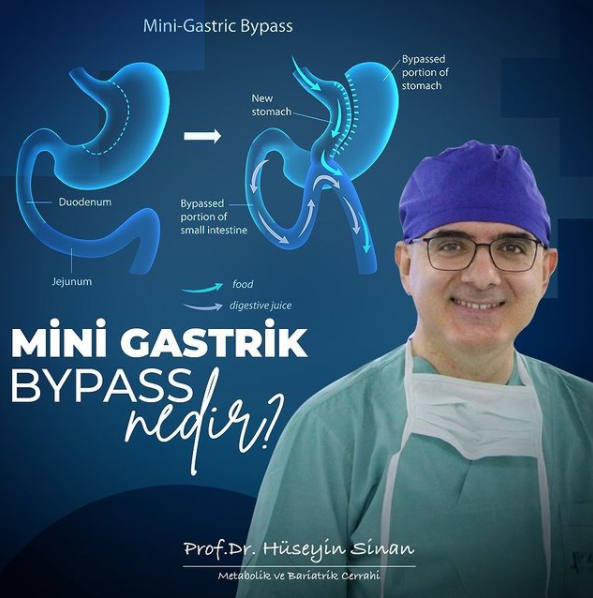 Mini Gastrik Bypass Nedir?
