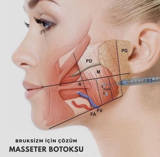 Masseter kasına Botoks makalesi