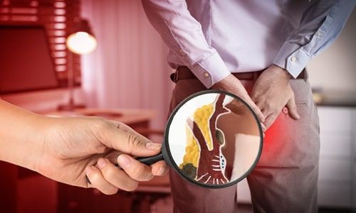 Hemoroidal Hastalık Hakkında makalesi