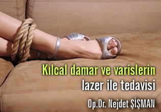 Kılcal damar ve varislerin lazer ile tedavisi makalesi