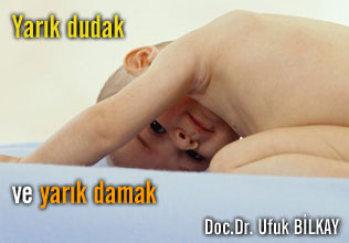 Yarık dudak ve yarık damak
