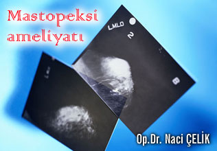 Mastopeksi ameliyatında karşılaşabileceğiniz problemler