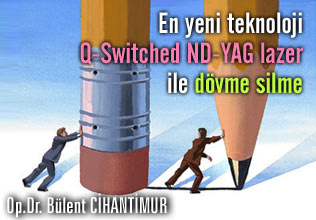 En yeni teknoloji q-switched nd-yag lazer ile dövme silme