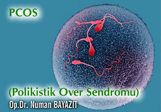 Pcos (polikistik over sendromu)