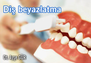 Diş beyazlatma!