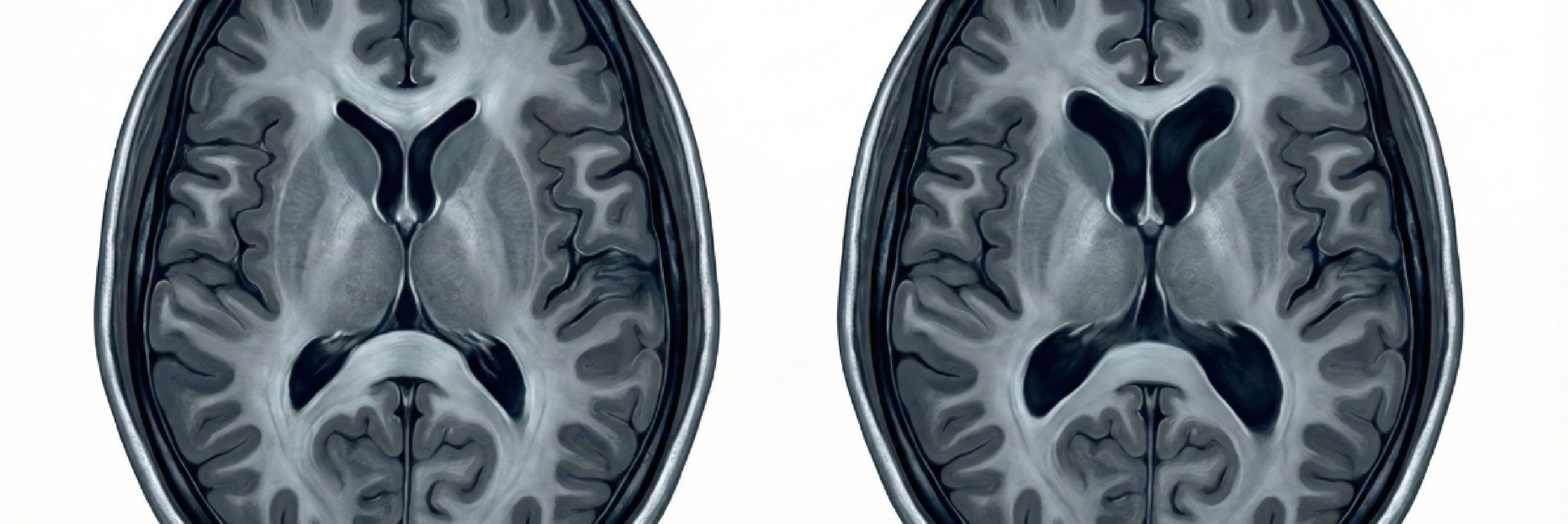 Beyin MR’ında “Sıvı Artışı” Görüldü: Ne Zaman Ciddi Bir Sorun?