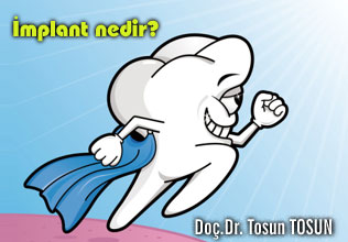 İmplant nedir? kimlere implant uygulanabilir?