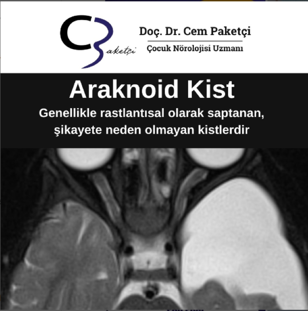 ARAKNOİD KİST