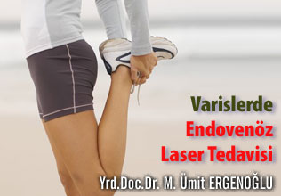 Varislerde endovenöz lazer tedavisi