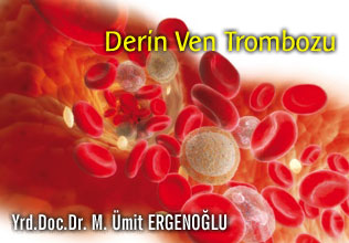 Derin ven trombozu (dvt) hakkında bilmemiz gerekenler