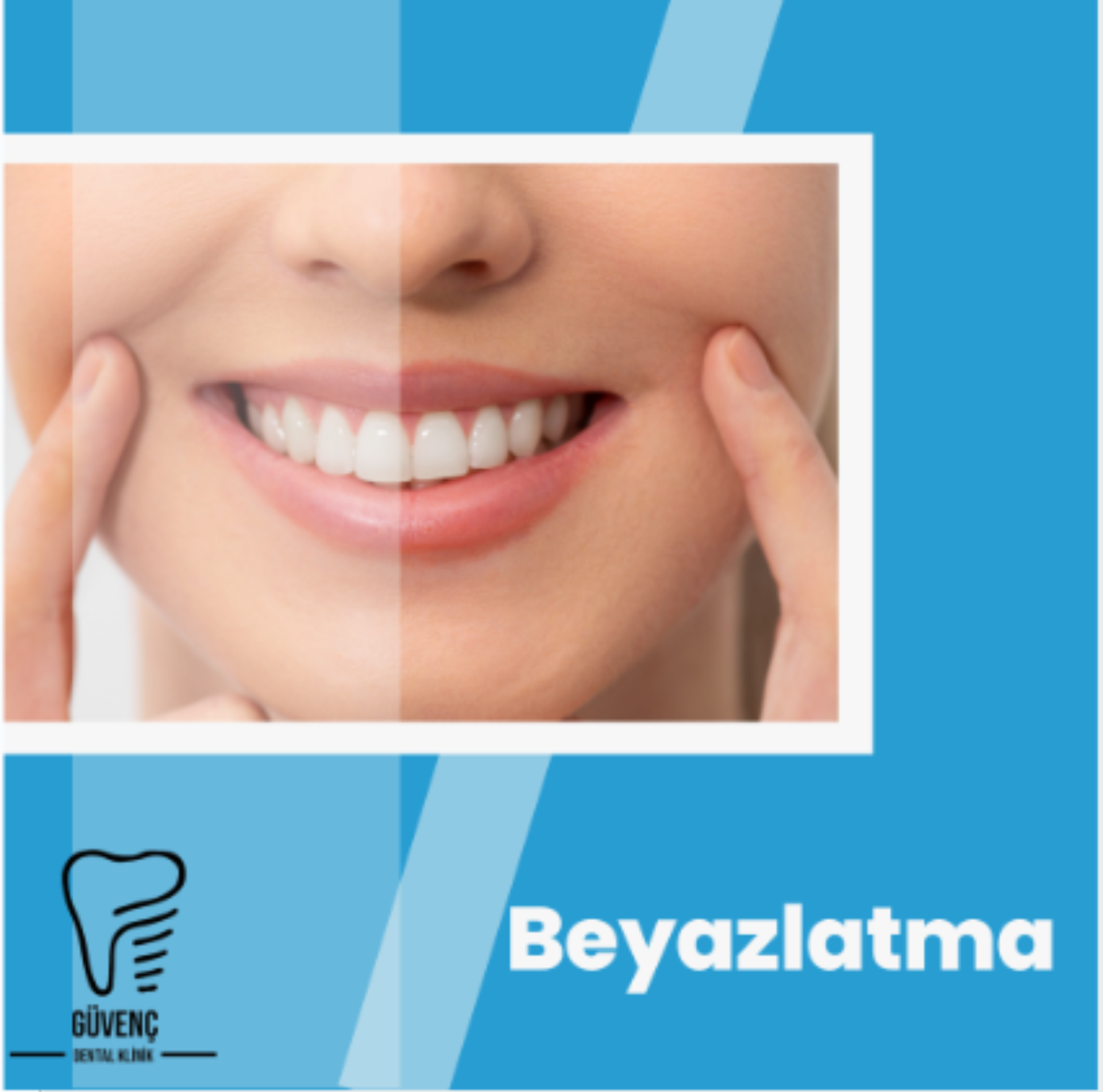 Diş Beyazlatma: Yöntemler, Etkiler ve Dikkat Edilmesi Gerekenler