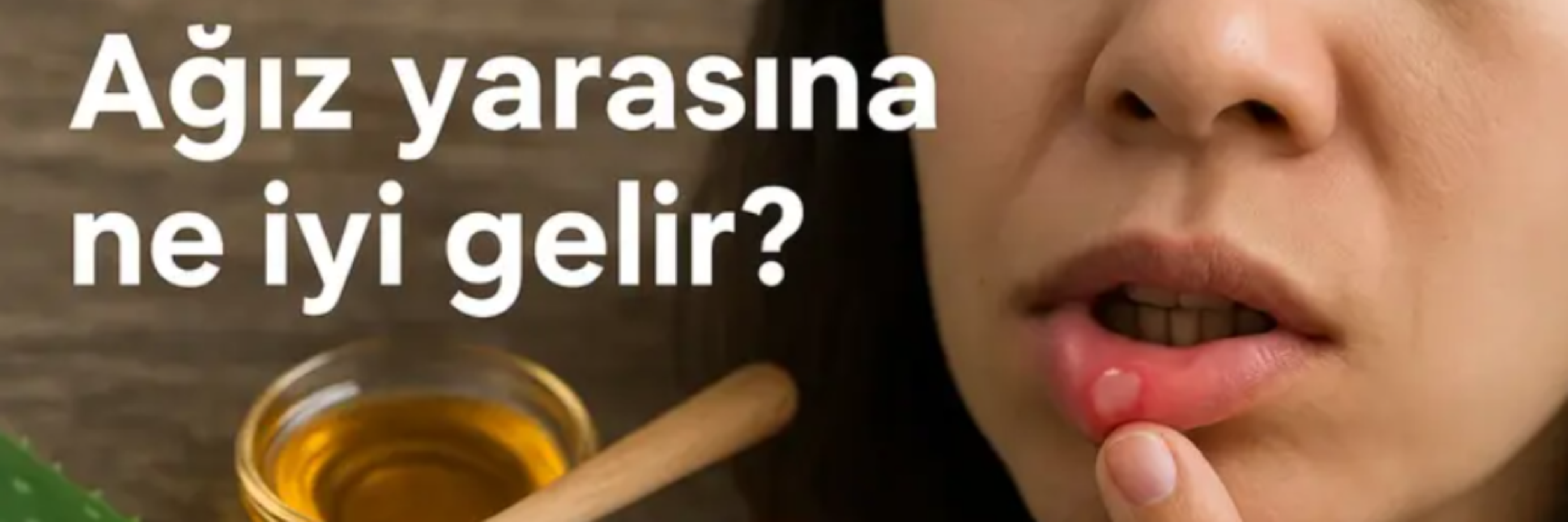 Ağız yarasına ne iyi gelir