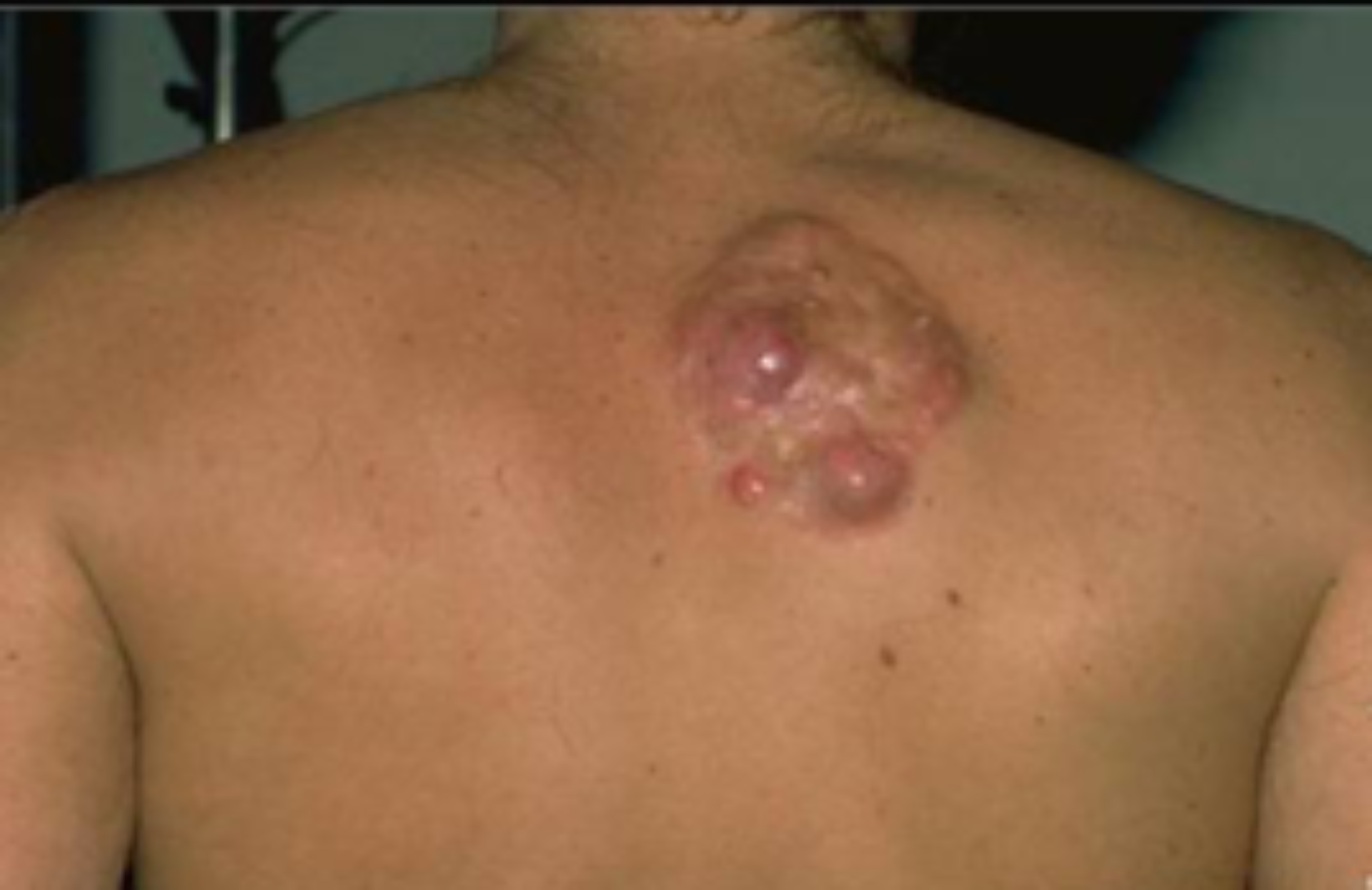 Dermatofibrosarkoma protuberans (DFSP)