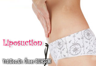 Liposuction (yağ alma)