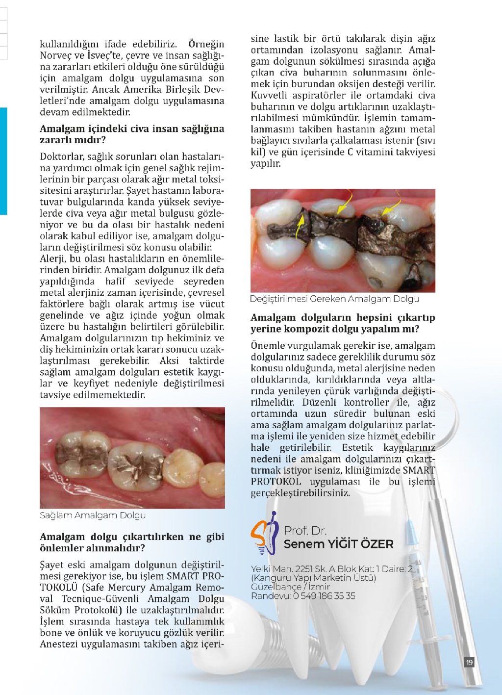 Amalgam Dolgular Değiştirilmeli midir? Bölüm 2