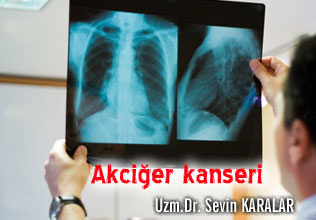 Akciğer kanserinde erken korunma tanı ve tadavi yöntemleri