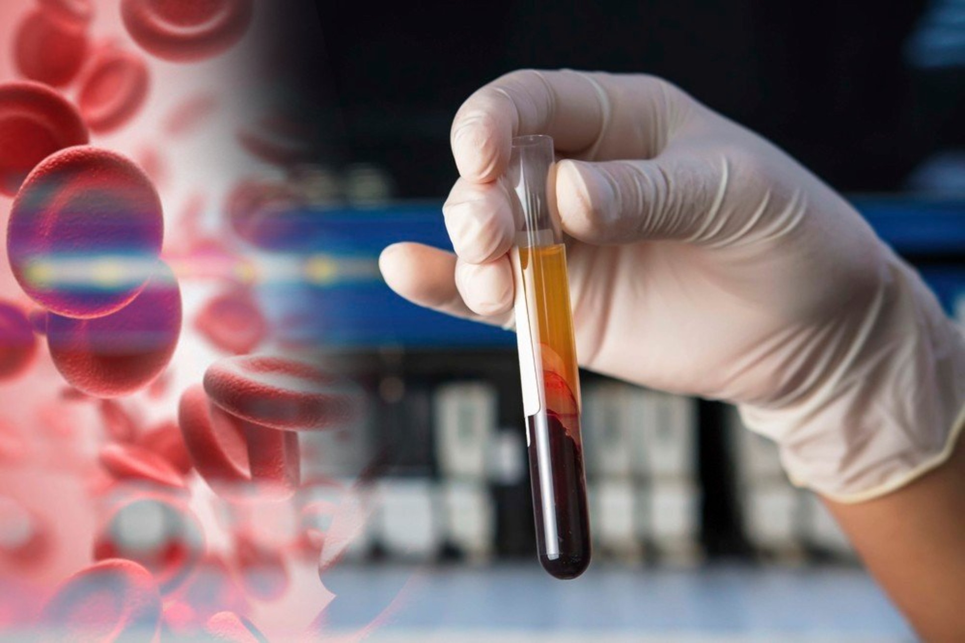 Platelet Rich Plasma - PRP