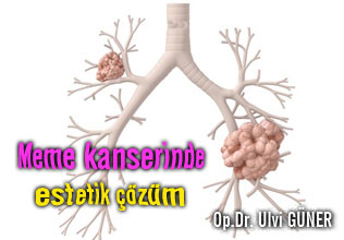 Meme kanserinde estetik çözüm