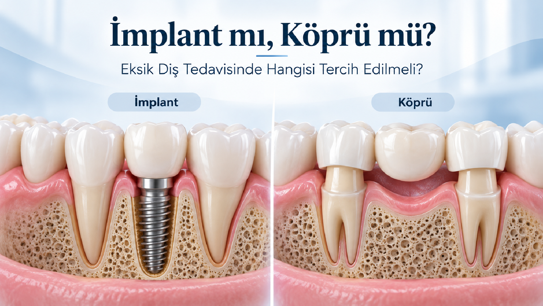 İmplant mı Köprü mü? Eksik Diş Tedavisinde Hangisi Daha İyi? Avantajları ve Farkları
