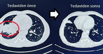 AKCİĞER KANSERİNDE HEDEFE YÖNELİK (AKILLI İLAÇ) TEDAVİ makalesi