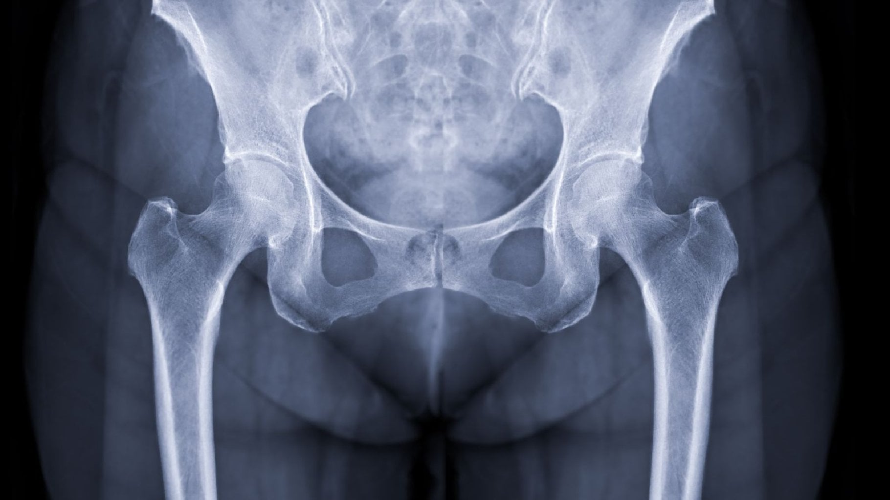 Kalça Eklemi Osteoartrit ( Kireçlenme)