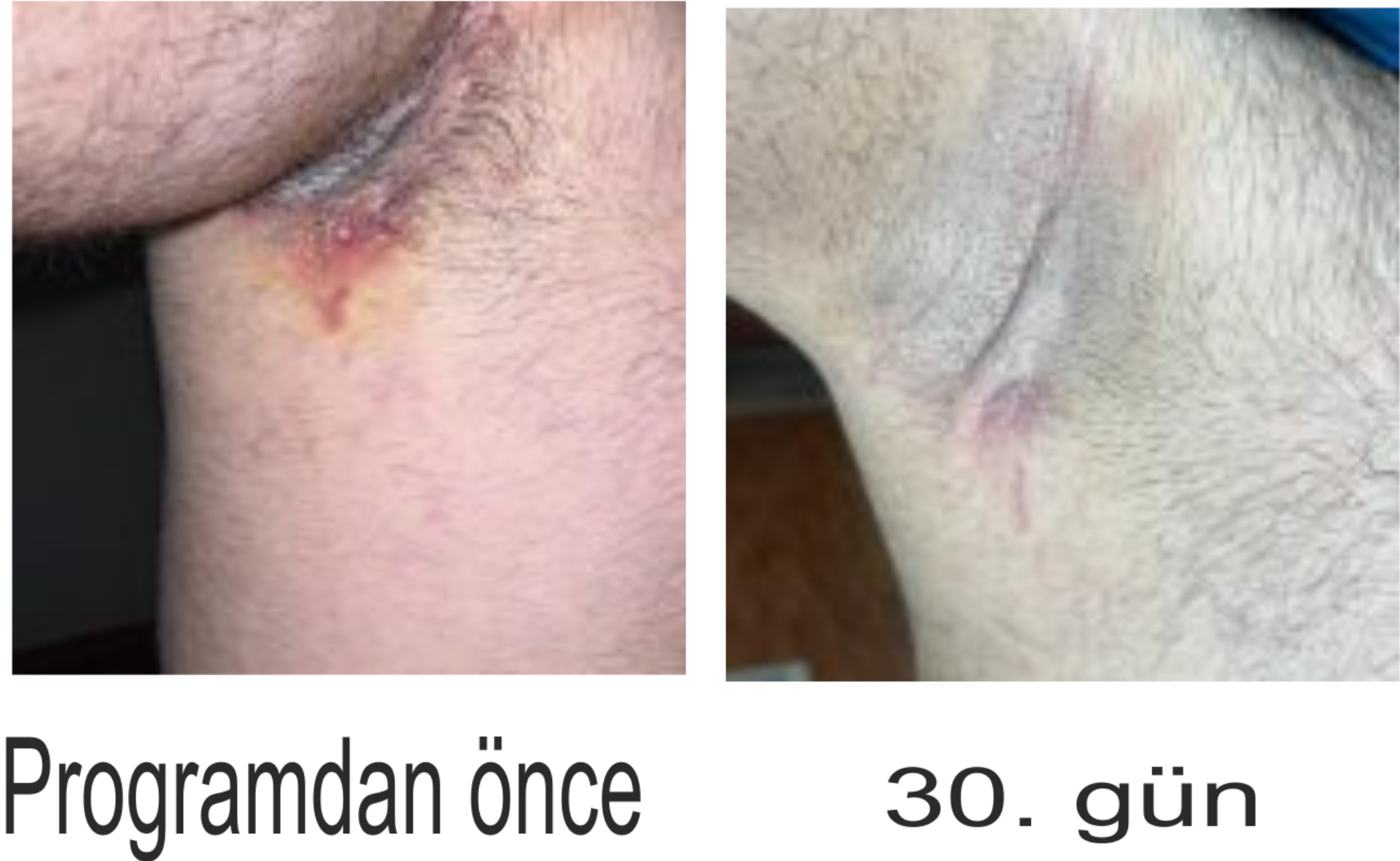 Hidradenitis Suppurativa - Köpek Memesi Hastalığı