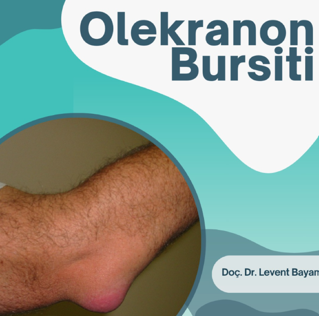 Olekranon Bursiti makalesi