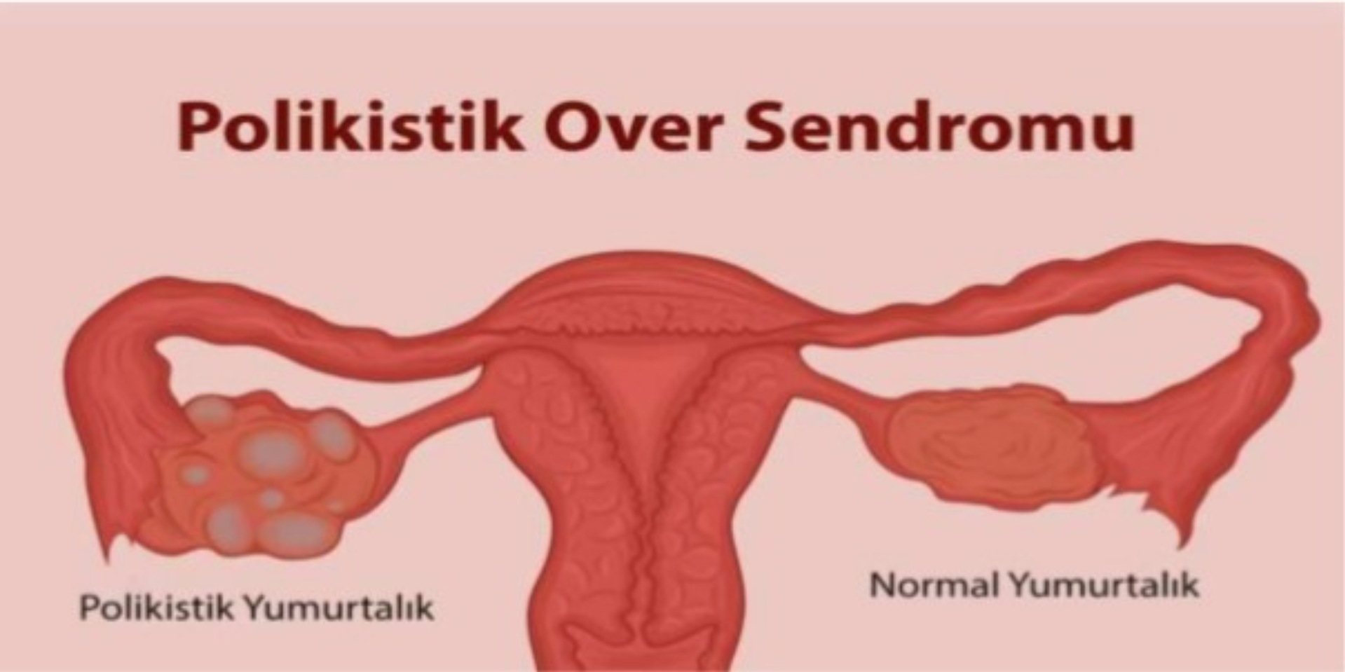 POLİKİSTİK OVER SENDROMU