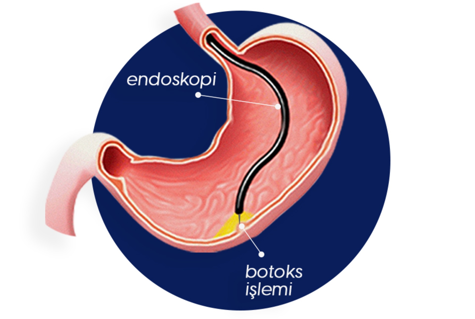 MİDE BOTOKSU İLE İDEAL KİLONUZA KAVUŞUN!