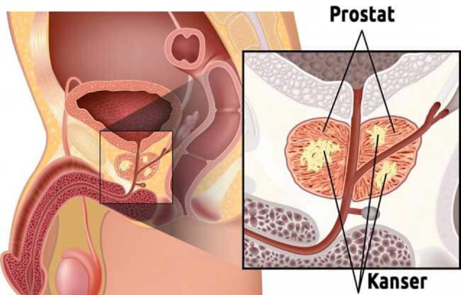 Prostat Hastalığı