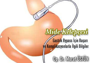 Mide kelepçesi ve gastrik bypass için başarı ve komplikasyonlarla ilgili bilgiler