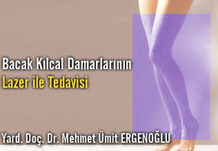 Bacak kılcal damarlarının lazer ile tedavisi