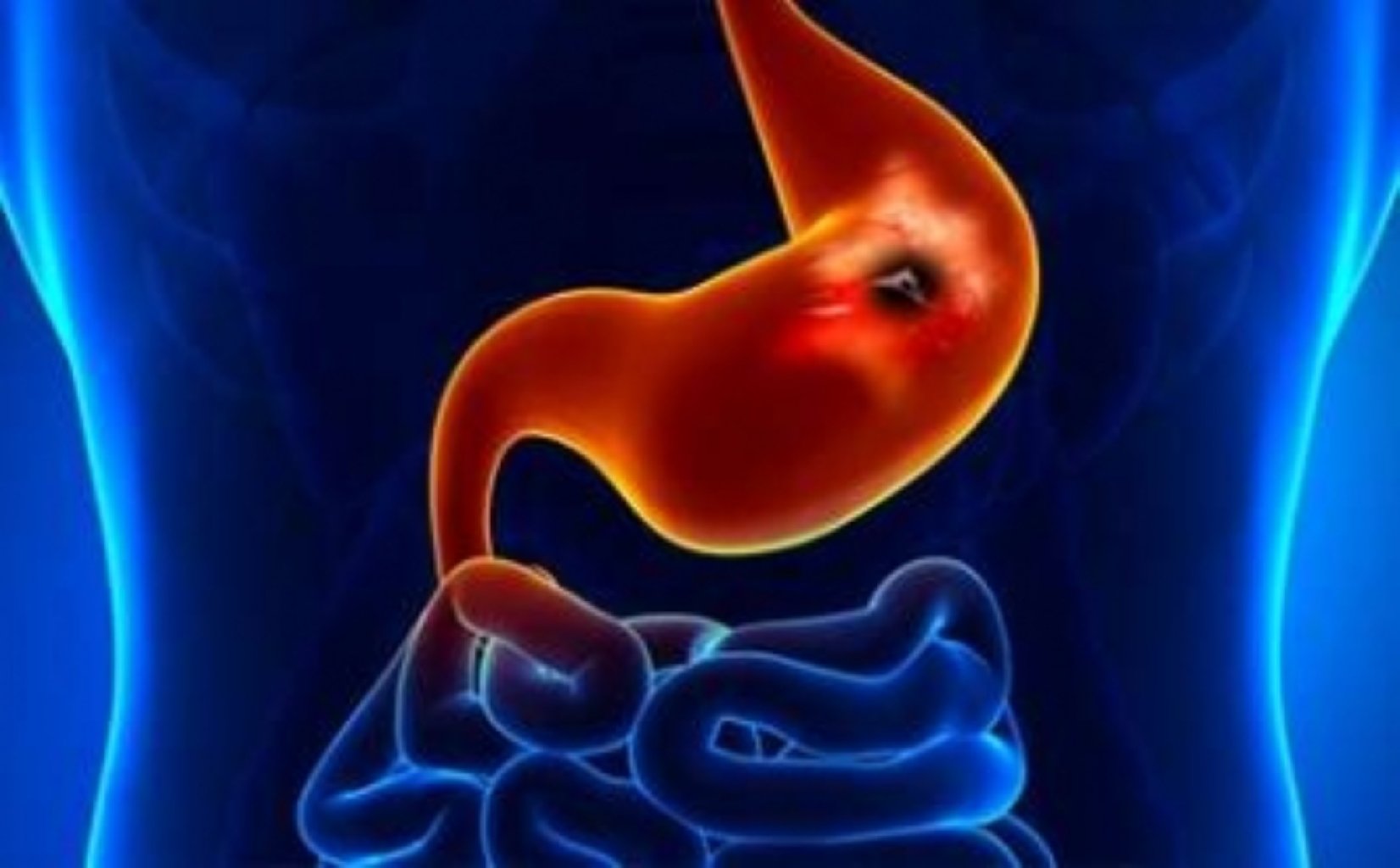 Peptik ülser nedir ?