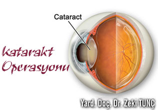 Katarakt operasyonu
