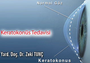 Keratokonüs tedavisi