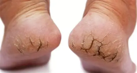 Topuk Çatlakları Neden Olur? 👣😳 Bir Türlü Geçmeyen Çatlakların Sebebi Ne?
