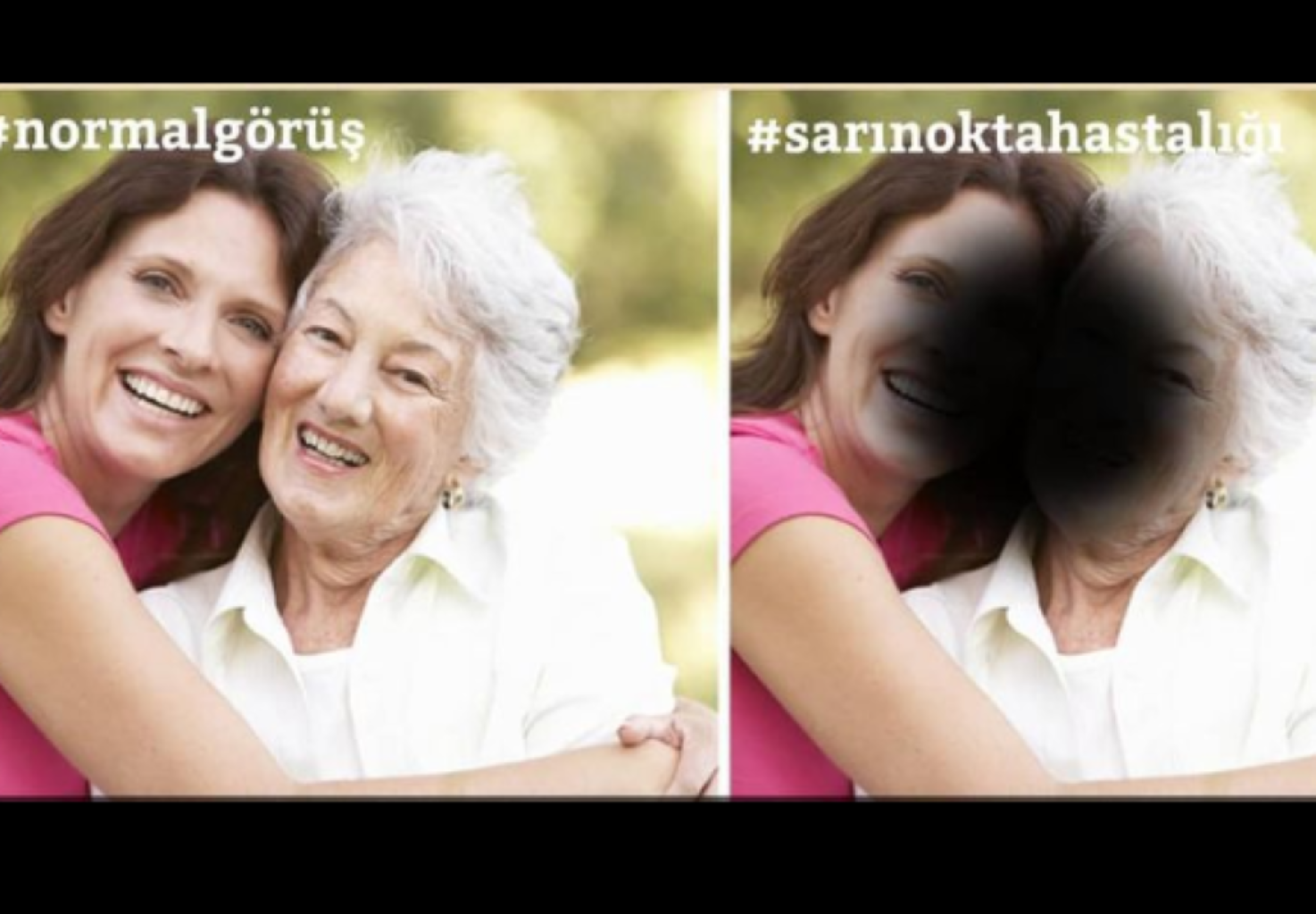 Sarı nokta hastalığı nedir?  Tedavisi mümkün müdür?