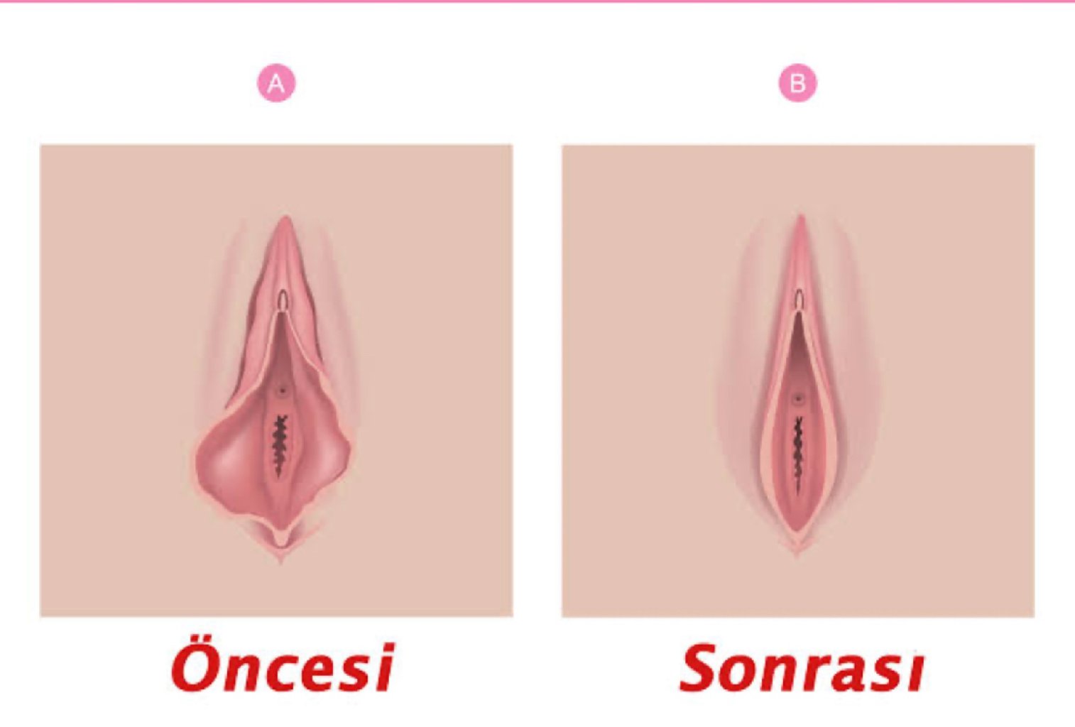 Labioplasti hakkında bilmedikleriniz