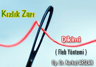 Kızlık zarı dikimi - fleb yöntemi