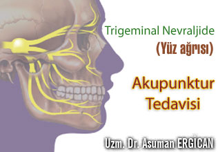 Trigeminal nevraljide (yüz ağrısı) akupunktur tedavisi